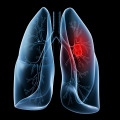 Lung Cancer Essay